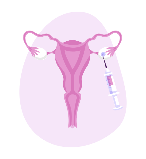 Puncture or aspiration of follicular fluid containing mature eggs