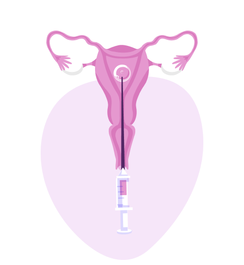 Transfer of embryos into the uterine cavity.